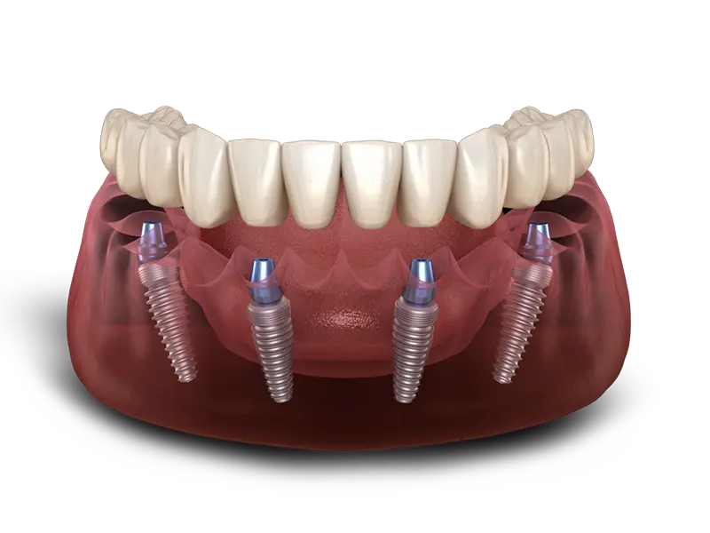 Porcelain Veneers Dominican Republic